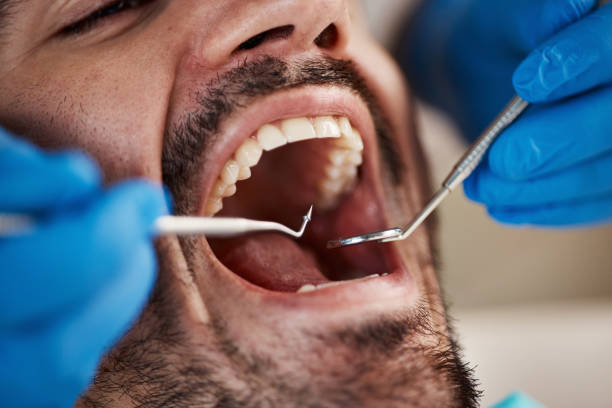 Best Emergency Wisdom Tooth Extraction in Norristown, PA